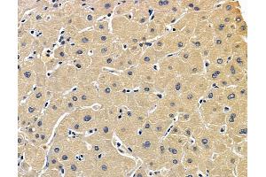 ABIN7096894 and ABIN7100960 at 1/100 staining human liver cancer by IHC-P.