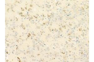 ABIN6264416 and ABIN6279652 at 1/100 staining human melanoma by IHC-P. (PREX1 抗体  (Internal Region))