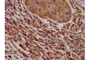 IHC image of ABIN7163609 diluted at 1:600 and staining in paraffin-embedded human pancreatic cancer performed on a Leica BondTM system. (PAFAH1B3 抗体  (AA 103-187))