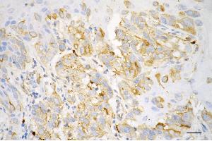 Immunohistochemistry was performed on paraffin-embedded human melanoma using oxysterol binding protein like 1A antibody (ABIN7799716), 1:200). (Recombinant OSBPL1A 抗体)
