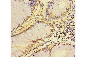 Immunohistochemistry of paraffin-embedded human colon cancer using ABIN7162535 at dilution of 1:100 (ZDHHC15 抗体  (AA 239-337))