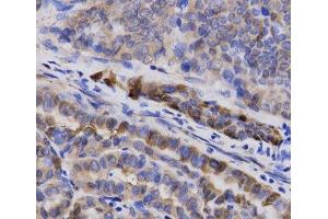Immunohistochemistry of paraffin-embedded Human thyroid cancer using SNCG Polyclonal Antibody at dilution of 1:200 (40x lens). (SNCG 抗体)