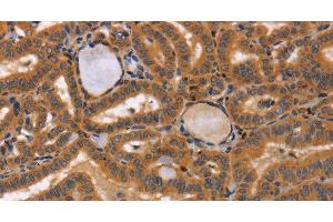 Immunohistochemistry of paraffin-embedded Human thyroid cancer tissue using CCL23 Polyclonal Antibody at dilution 1:50 (CCL23 抗体)