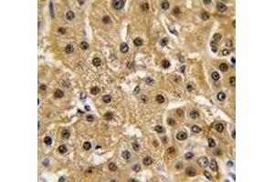 IHC analysis of FFPE human hepatocarcinoma tissue stained with c-Abl antibody (ABL1 抗体  (AA 741-769))