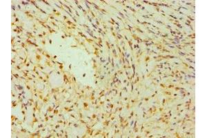 Immunohistochemistry of paraffin-embedded human breast cancer using ABIN7142266 at dilution of 1:100 (DAP3 抗体  (AA 159-398))
