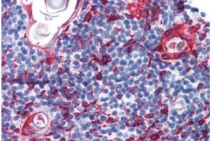 Human Thymus (formalin-fixed, paraffin-embedded) stained with KRT13 antibody ABIN364278 at 10 ug/ml followed by biotinylated anti-mouse IgG secondary antibody ABIN481714, alkaline phosphatase-streptavidin and chromogen. (Cytokeratin 13 抗体)