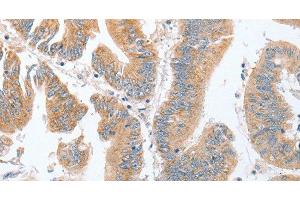 Immunohistochemistry of paraffin-embedded Human colon cancer tissue using PARD6A Polyclonal Antibody at dilution 1:60 (PARD6A 抗体)