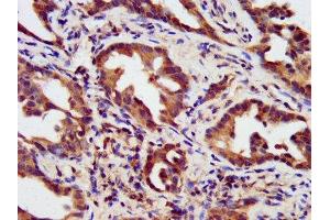 IHC image of ABIN7155861 diluted at 1:200 and staining in paraffin-embedded human lung cancer performed on a Leica BondTM system. (HIPK1 抗体  (AA 1007-1151))