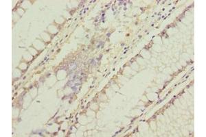 Immunohistochemistry of paraffin-embedded human colon cancer using ABIN7174715 at dilution of 1:100 (C11orf53 抗体  (AA 13-236))