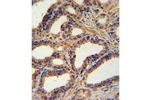 Formalin-fixed and paraffin-embedded human prostate carcinoma with NA Antibody (N-term), which was peroxidase-conjugated to the secondary antibody, followed by DAB staining. (NPPA 抗体  (N-Term))