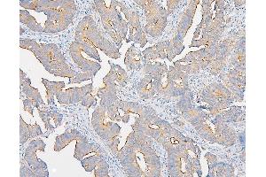 IHC analysis of IQGAP1 using anti-IQGAP1 antibody (ABIN6719262).