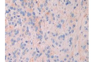 DAB staining on IHC-P; Samples: Human Prostate cancer Tissue (MEPE 抗体  (AA 212-445))