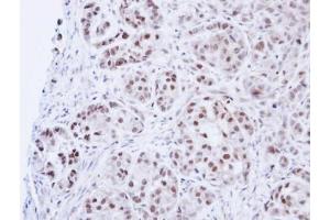 IHC-P Image Immunohistochemical analysis of paraffin-embedded A549 Xenograft, using DNA ligase 3, antibody at 1:100 dilution. (LIG3 抗体)