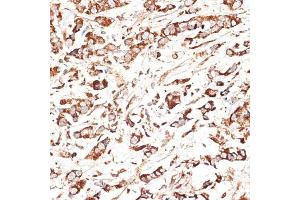Immunohistochemistry of paraffin-embedded human breast cancer using KLHL9 antibody (ABIN6132083, ABIN6142940, ABIN6142941 and ABIN6214299) at dilution of 1:100 (40x lens). (KLHL9 抗体  (AA 1-100))