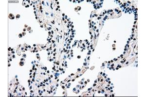 Immunohistochemical staining of paraffin-embedded Adenocarcinoma of breast tissue using anti-MAP2K4 mouse monoclonal antibody. (MAP2K4 抗体)