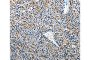 Immunohistochemistry of Human liver cancer using EPHB3 Polyclonal Antibody at dilution of 1:50 (EPH Receptor B3 抗体)