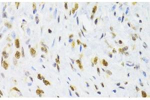 Immunohistochemistry of paraffin-embedded Human gastric cancer using DOK1 Polyclonal Antibody at dilution of 1:100 (40x lens). (DOK1 抗体)