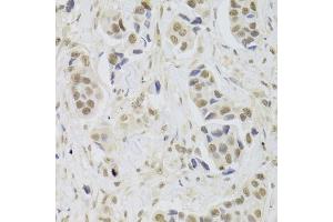 Immunohistochemistry of paraffin-embedded human breast cancer using UBE3C Antibody (ABIN5973842) at dilution of 1/100 (40x lens).