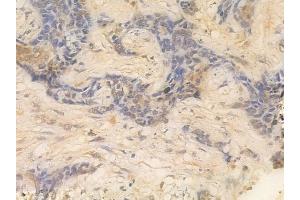 ABIN6261139 and ABIN6266523 at 1/100 staining human breast carcinoma by IHC-P. (Cyclin A1 抗体  (C-Term))