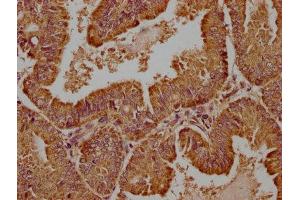 IHC image of ABIN7175790 diluted at 1:100 and staining in paraffin-embedded human endometrial cancer performed on a Leica BondTM system. (WDR73 抗体  (AA 163-366))