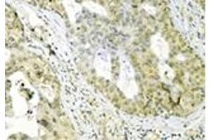 Immunohistochemistry analysis of human breast cancer tissue immunohistochemically stained using Grp75 mAb (30A5). (HSPA9 抗体)