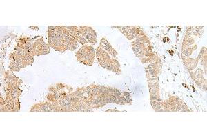 Immunohistochemistry of paraffin-embedded Human liver cancer tissue using PSMA4 Polyclonal Antibody at dilution of 1:50(x200) (PSMA4 抗体)