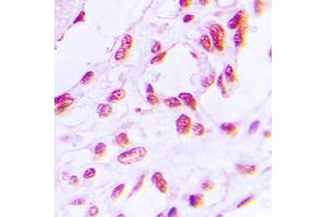 Immunohistochemical analysis of RB1 (pS780) staining in human breast cancer formalin fixed paraffin embedded tissue section.