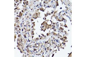 Immunohistochemistry of paraffin-embedded human lung cancer using PHD3 Rabbit pAb (ABIN6130355, ABIN6139990, ABIN6139991 and ABIN6224021) at dilution of 1:150 (40x lens). (EGLN3 抗体  (AA 1-120))