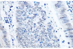 Immunohistochemistry of paraffin-embedded Human colon carcinoma using ADAR Polyclonal Antibody at dilution of 1:100 (40x lens). (ADAR 抗体)