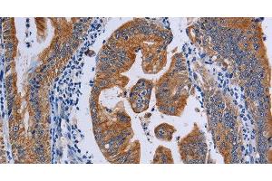 Immunohistochemistry of paraffin-embedded Human gasrtic cancer tissue using ACP6 Polyclonal Antibody at dilution 1:50 (ACP6 抗体)