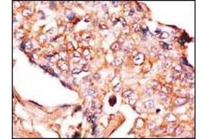 Formalin-fixed and paraffin-embedded human breast carcinoma reacted with anti-NP1(Nptx1) Antibody (Center), which was peroxidase-conjugated to the secondary antibody, followed by DAB staining. (NPX1 抗体  (AA 174-203))