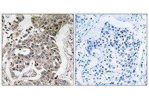 Immunohistochemistry analysis of paraffin-embedded human breast carcinoma tissue using PPP2R1B antibody. (PPP2R1B 抗体  (C-Term))