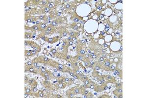 Immunohistochemistry of paraffin-embedded human liver injury using HYAL1 antibody (ABIN5975045) at dilution of 1/100 (40x lens). (HYAL1 抗体)
