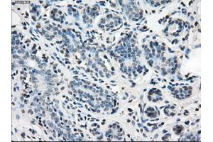 Immunohistochemical staining of paraffin-embedded breast tissue using anti-IDH1 mouse monoclonal antibody. (IDH1 抗体)