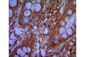 Immunohistochemical analysis of paraffin-embedded colon cancer tissues using CHD3 mouse mAb with DAB staining. (CHD3 抗体)