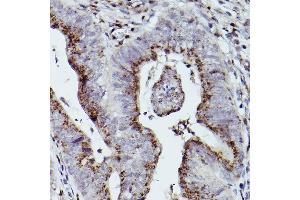 Immunohistochemistry of paraffin-embedded human colon carcinoma using GOLGB1 Rabbit pAb (ABIN7267498) at dilution of 1:100 (40x lens). (Golgin B1 (GOLGB1) 抗体)
