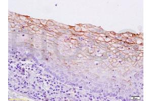 Formalin-fixed and paraffin embedded human breast carcinoma labeled with Anti-pan Cytokeratin Polyclonal Antibody, Unconjugated  at 1:200 followed by conjugation to the secondary antibody and DAB staining. (pan Keratin 抗体  (AA 331-430))
