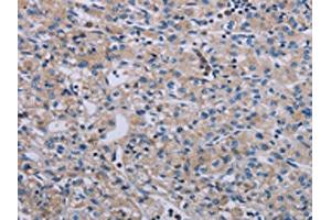 The image on the left is immunohistochemistry of paraffin-embedded Human prostate cancer tissue using ABIN7191769(PAGE4 Antibody) at dilution 1/40, on the right is treated with synthetic peptide. (PAGE4 抗体)