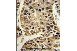Formalin-fixed and paraffin-embedded human hepatocarcinoma reacted with SERPINA4 Antibody (C-term), which was peroxidase-conjugated to the secondary antibody, followed by DAB staining. (SERPINA4 抗体  (C-Term))