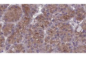 ABIN6273986 at 1/100 staining Human liver cancer tissue by IHC-P. (OR2W1 抗体  (C-Term))
