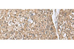 Immunohistochemistry of paraffin-embedded Human esophagus cancer tissue using EIF4A2 Polyclonal Antibody at dilution of 1:65(x200) (EIF4A2 抗体)