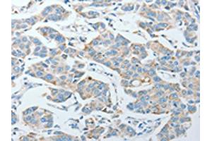 The image on the left is immunohistochemistry of paraffin-embedded Human lung cancer tissue using ABIN7128282(AGA Antibody) at dilution 1/20, on the right is treated with fusion protein. (AGA 抗体)