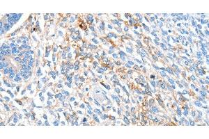 Immunohistochemistry of paraffin-embedded Human ovarian cancer using ALDH1A2 Polyclonal Antibody at dilution of 1:60 (ALDH1A2 抗体)