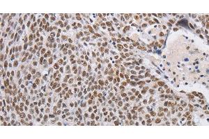 Immunohistochemistry of paraffin-embedded Human lung cancer using THOC7 Polyclonal Antibody at dilution of 1:30 (THOC7 抗体)