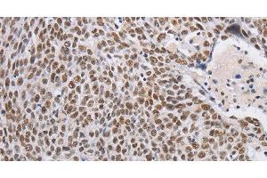 Immunohistochemistry of paraffin-embedded Human lung cancer using THOC7 Polyclonal Antibody at dilution of 1:30
