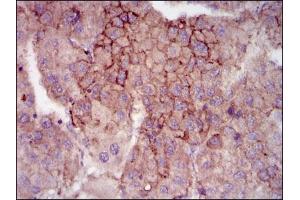 Immunohistochemical analysis of paraffin-embedded liver cancer tissues using MELK mouse mAb with DAB staining. (MELK 抗体  (AA 637-651))