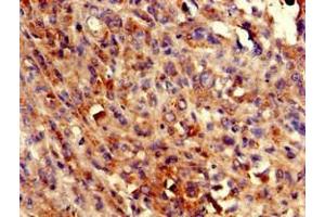 Immunohistochemistry of paraffin-embedded human melanoma using ABIN7145071 at dilution of 1:100 (COQ8B 抗体  (AA 10-137))