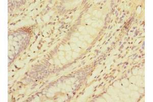 Immunohistochemistry of paraffin-embedded human colon cancer using ABIN7158359 at dilution of 1:100 (LMO3 抗体  (AA 1-145))