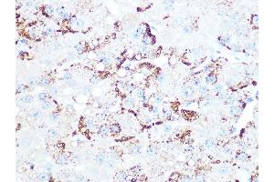 Immunohistochemistry of paraffin-embedded human liver cancer using Cathepsin L/V/K/H Rabbit mAb (ABIN7266150) at dilution of 1:100 (40x lens). (Cathepsin L 抗体)
