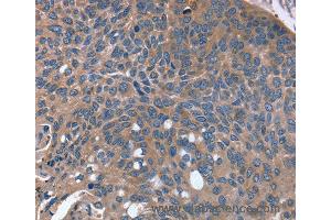 Immunohistochemistry of Human esophagus cancer using RGS4 Polyclonal Antibody at dilution of 1:30 (RGS4 抗体)